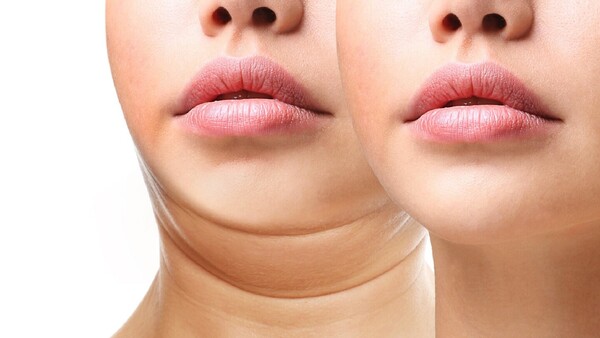 ¿En qué consiste una lipoaspiración de papada y cuáles son sus riesgos?