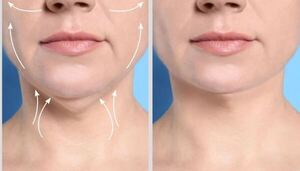 La “lipopapada” debe ser realizada por un personal entrenado y certificado, advierte médico