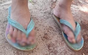Niña de 7 años fue internada por infección severa de piques - 1000 Noticias