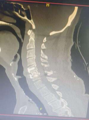 Médicos de IPS de CDE realizaron histórica cirugía en trauma cervical - Nacionales - ABC Color
