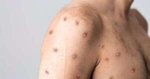 La Nación / La OMS no baja su nivel de alerta máxima por epidemia de mpox o viruela del mono