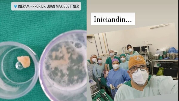 Comió puchero y terminó con un hueso en el pulmón