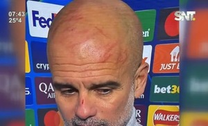 Guardiola Causa Polémica tras Aparición con Rasguños en el Rostro - SNT