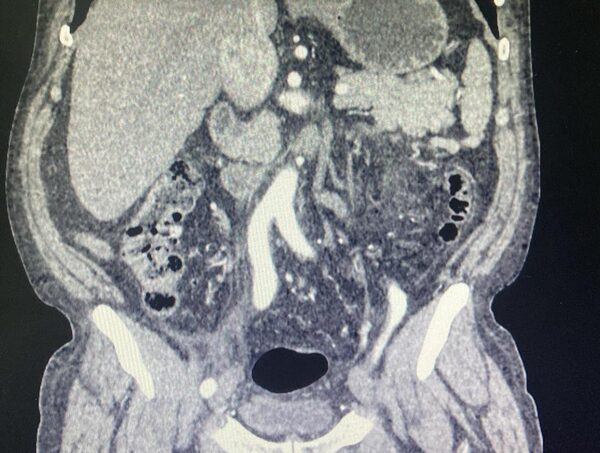 En IPS se realiza segunda supercirugía para extraer tumor renal · Radio Monumental 1080 AM