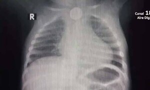 Niño de un año tragó una pila y debe someterse a un procedimiento de urgencia – Prensa 5