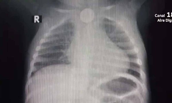 Niño de un año tragó una pila y debe someterse a un procedimiento de urgencia – Prensa 5