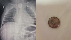 Niño tragó una pila de reloj y se encuentra delicado en el Ineram - Noticiero Paraguay