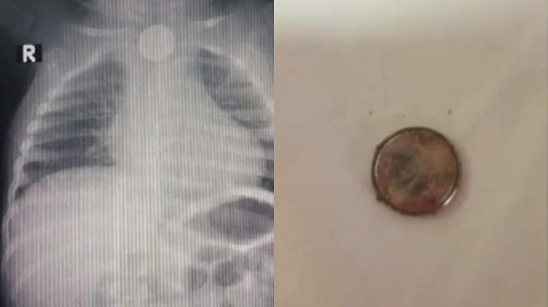 Niño tragó una pila de reloj y se encuentra delicado en el Ineram - Noticiero Paraguay