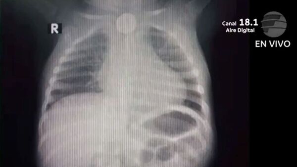 Bebé tragó pila de un reloj y está grave