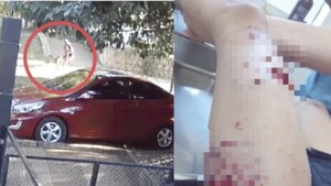 Pitbull mordió a niña de 6 años y dueños del perro se mudan de casa