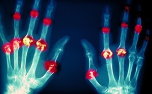 ¿Qué alimentos ayudan a prevenir la artritis y cuáles infusiones comunes pueden elevar el riesgo?