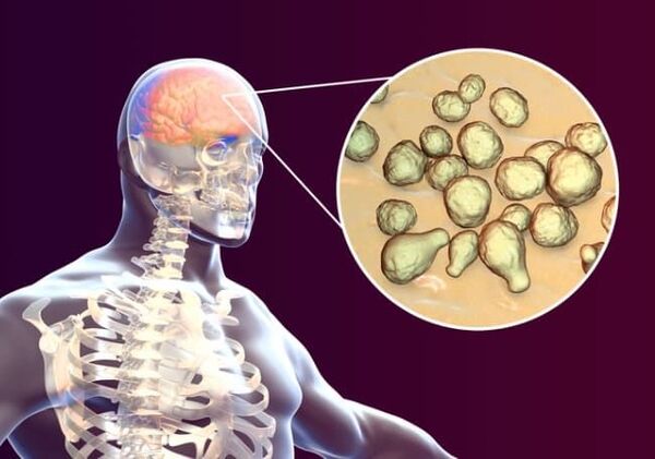 Aumento de casos de meningoencefalitis generó una alerta en sistema sanitario del Paraguay