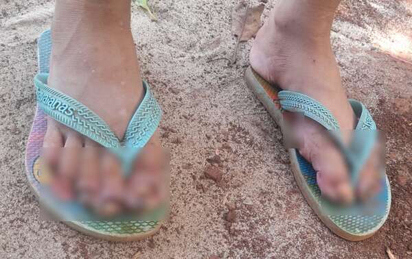 Niña infestada de piques habría sido abusada, pero investigación casi no avanza - ABC en el Este - ABC Color