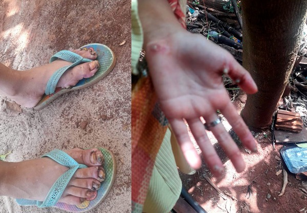 Niña rescatada con piques también fue víctima de abuso sexual - ADN Digital