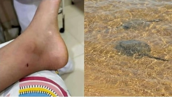 Niños fueron picados por rayas en la playa San José de Encarnación - ADN Digital