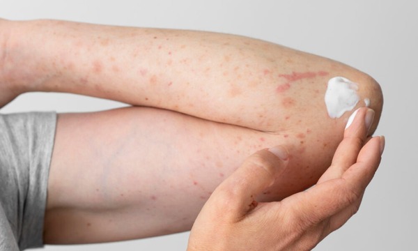 La psoriasis y el verano: cuidados para proteger la piel en época de altas temperaturas