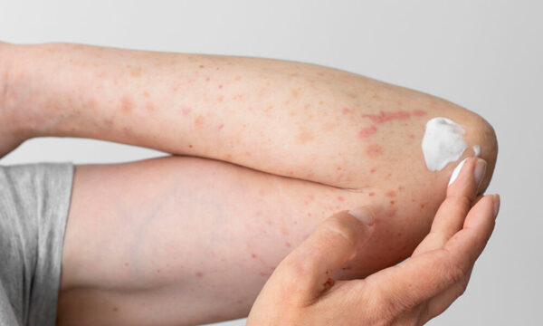 La psoriasis y el verano: cuidados para proteger la piel en época de altas temperaturas