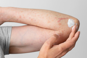 Recomiendan proteger la piel de pacientes con psoriasis en época de altas temperaturas - Unicanal