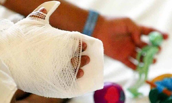Advierten sobre secuelas permanentes del uso de pirotecnia – Prensa 5