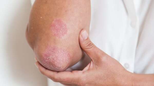 La psoriasis y el verano: consejos para proteger la piel en época de altas temperaturas - Nacionales - ABC Color