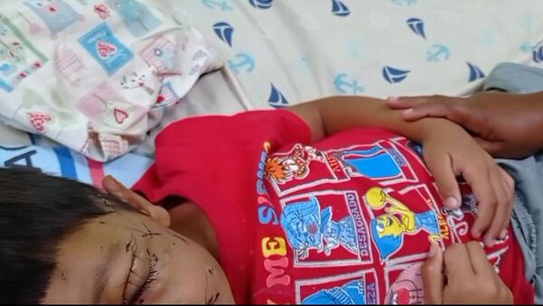 Perro desfiguró la cara de un niño de 5 años