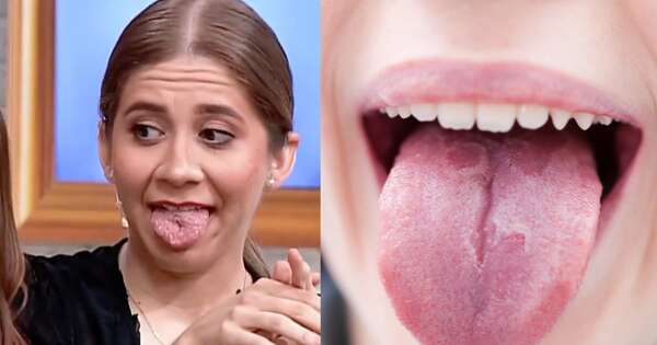 La Nación / “Lengua geográfica”: la afección benigna de Belén Rivas