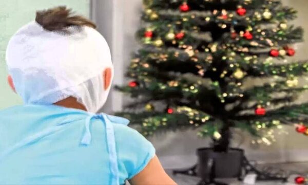 Niño se quemó la cara con Mbocavícho