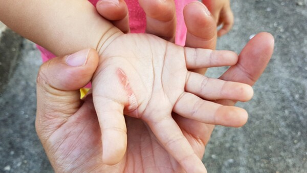 Motocas hieren con arma de hidrogel a beba de 10 meses