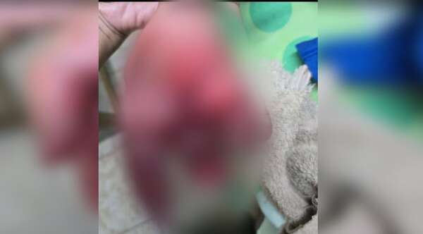 Niño perdió la punta de uno de sus dedos por explosión de petardos en Coronel Bogado - Noticiero Paraguay