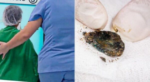 Niño que tragó una pila fue asistido con éxito por médicos