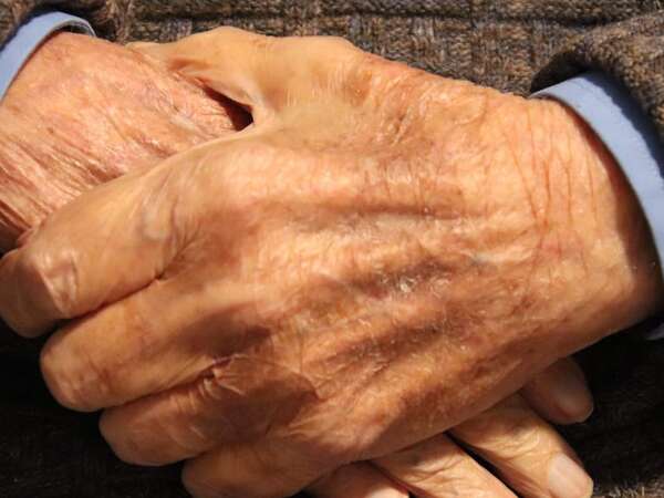 Día de la Lucha contra la Lepra: ¿a cuántas personas afecta la enfermedad en Paraguay? - Nacionales - ABC Color