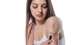 Cicatrices en queloide, ¿se pueden prevenir? - Estilo de vida - ABC Color