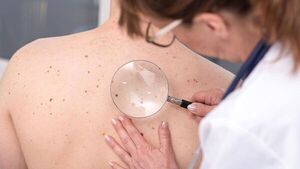 Desde el Ministerio de Salud instan a controlar los lunares - trece