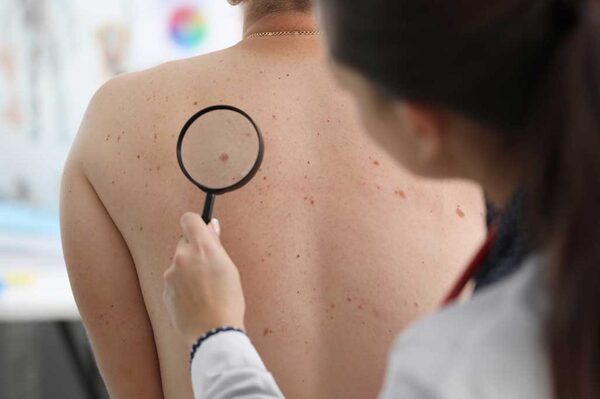 Ministerio de Salud recalca importancia de controlar los lunares - Unicanal