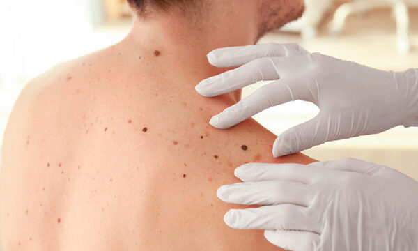 Melanoma: ¿cómo detectar un lunar que podría ser cáncer de piel?