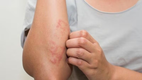 Leishmaniasis y lepra, enfermedades tropicales desatendidas - 1000 Noticias