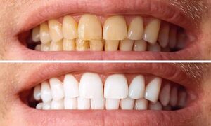 ¿Qué bebida o alimento mancha más los dientes?