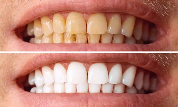 ¿Qué bebida o alimento mancha más los dientes?