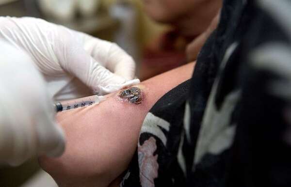 Leishmaniasis en Paraguay: más de 100 casos registrados en 2024 - Nacionales - ABC Color