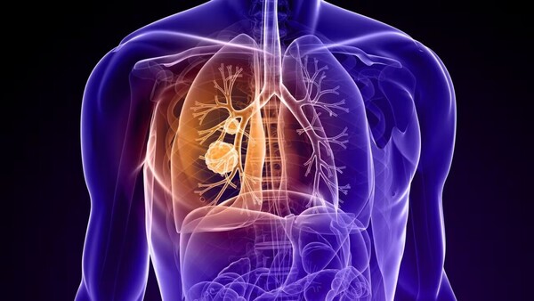 Cáncer en Paraguay: ¿cómo avanza la detección y el tratamiento?