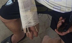 IPS San Antonio: Tuvo una fractura y le pusieron cartón en vez de yeso – Prensa 5
