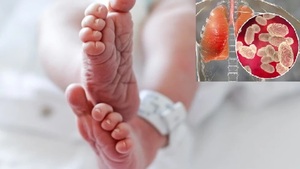 Alerta epidemiológica por aumento de casos de tos ferina y muerte de bebé