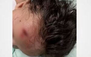 ¡Terrible!: Bebé de 3 meses herida en Clínicas tras caída de techo del ascensor