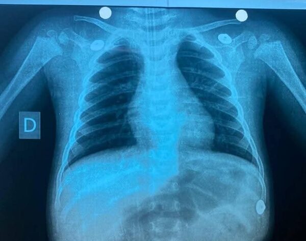 Bebé de 9 meses fue rescatada tras asfixiarse con hueso