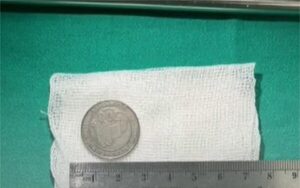 Ni que fuera alcancía, bebé de un año tragó moneda de 500