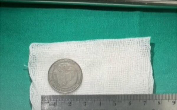 (Video) Ni que fuera alcancía, bebé de un año tragó moneda de 500