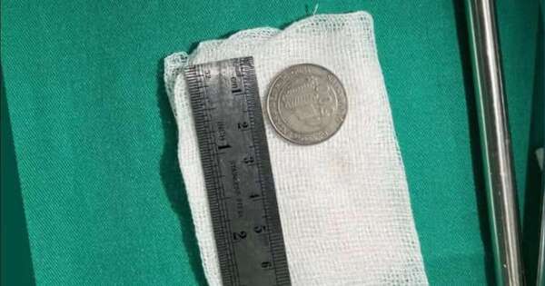 La Nación / Niña de un año tragó moneda de G. 500 y fue salvada por médicos del Ineram