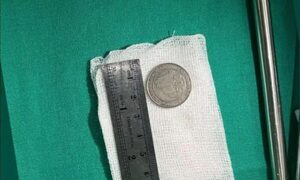 Niña de un año tragó moneda de G. 500 y fue salvada por médicos del Ineram