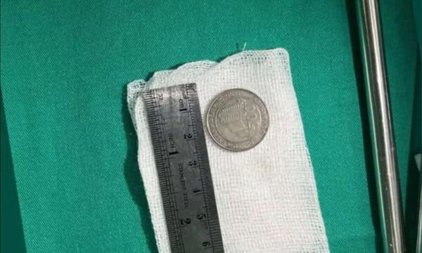 Niña de un año tragó moneda de G. 500 y fue salvada por médicos del Ineram