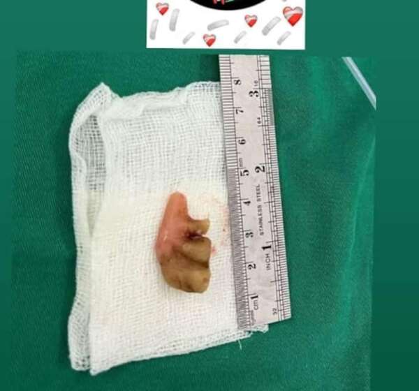 No era neumonía, tenía una prótesis dental en el pulmón - Nacionales - ABC Color